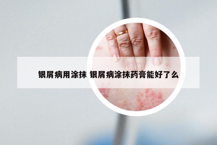 银屑病用涂抹 银屑病涂抹药膏能好了么