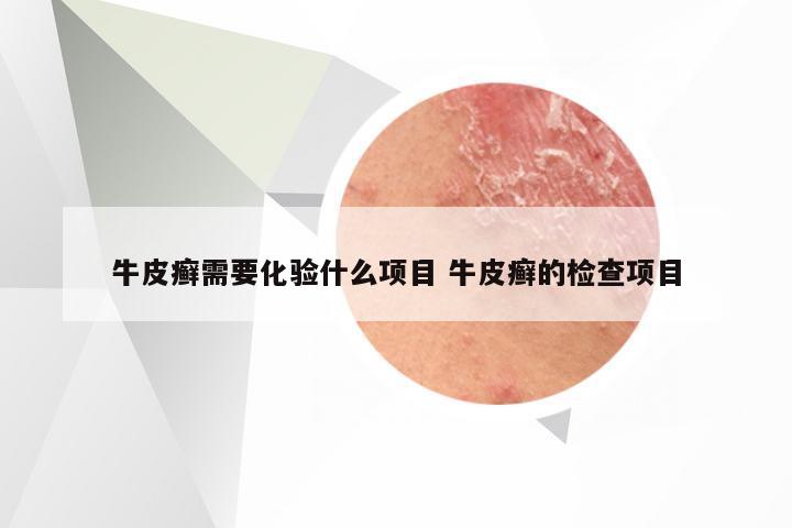 牛皮癣需要化验什么项目 牛皮癣的检查项目