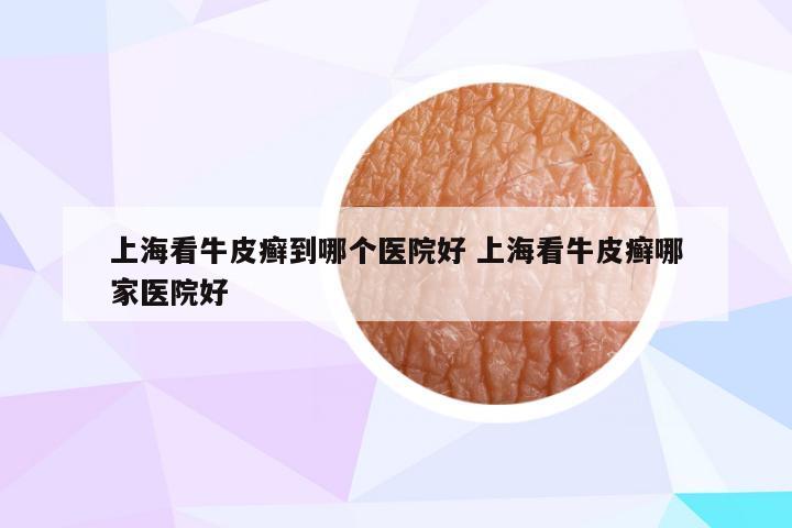 上海看牛皮癣到哪个医院好 上海看牛皮癣哪家医院好