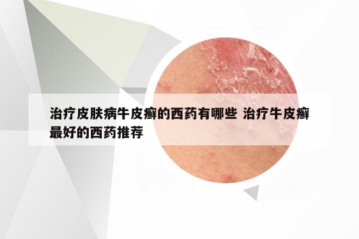 治疗皮肤病牛皮癣的西药有哪些 治疗牛皮癣最好的西药推荐
