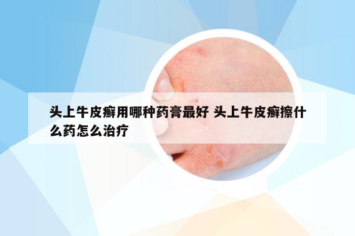 头上牛皮癣用哪种药膏最好 头上牛皮癣擦什么药怎么治疗