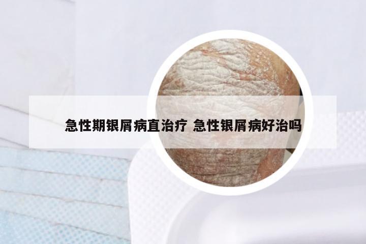 急性期银屑病直治疗 急性银屑病好治吗