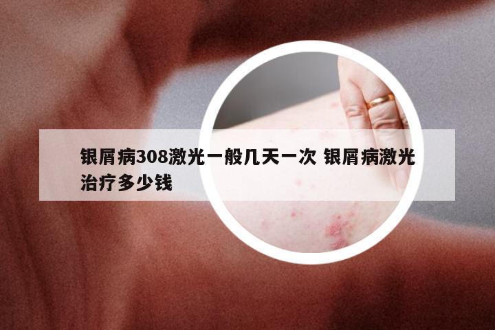 银屑病308激光一般几天一次 银屑病激光治疗多少钱
