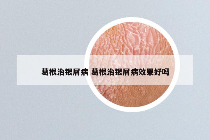葛根治银屑病 葛根治银屑病效果好吗