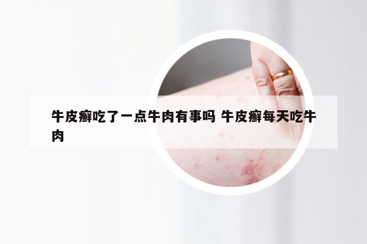 牛皮癣吃了一点牛肉有事吗 牛皮癣每天吃牛肉
