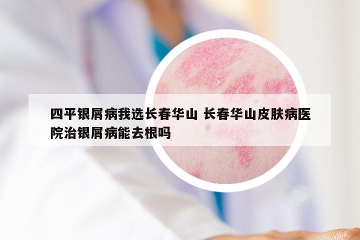 四平银屑病我选长春华山 长春华山皮肤病医院治银屑病能去根吗