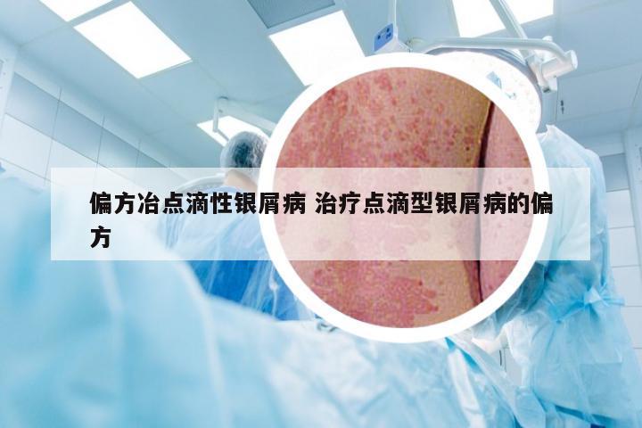 偏方冶点滴性银屑病 治疗点滴型银屑病的偏方