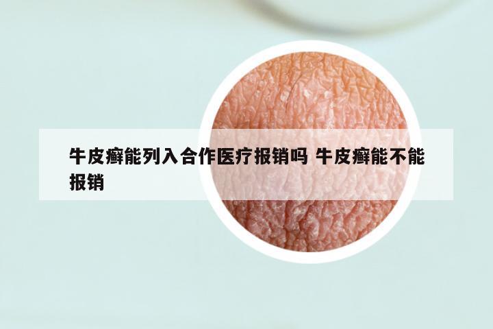 牛皮癣能列入合作医疗报销吗 牛皮癣能不能报销