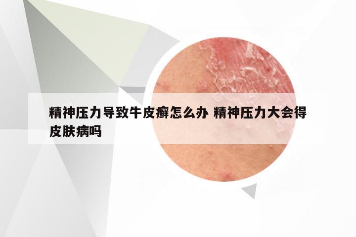 精神压力导致牛皮癣怎么办 精神压力大会得皮肤病吗