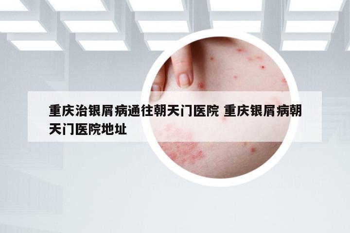 重庆治银屑病通往朝天门医院 重庆银屑病朝天门医院地址