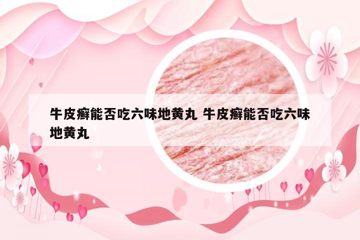 牛皮癣能否吃六味地黄丸 牛皮癣能否吃六味地黄丸