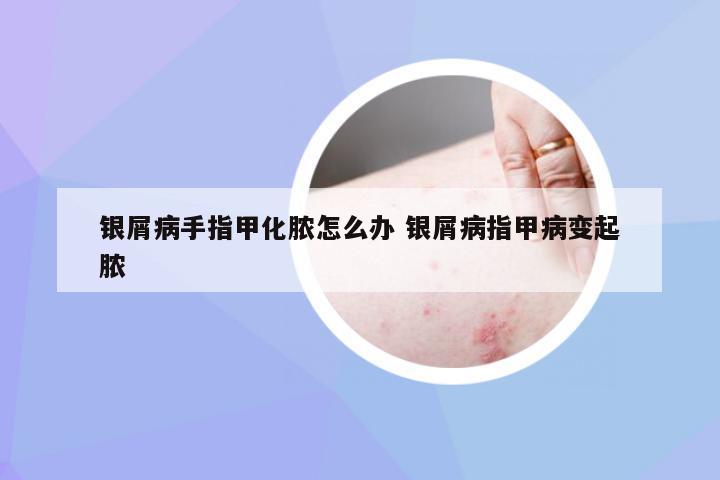 银屑病手指甲化脓怎么办 银屑病指甲病变起脓