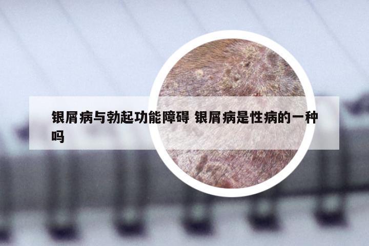银屑病与勃起功能障碍 银屑病是性病的一种吗