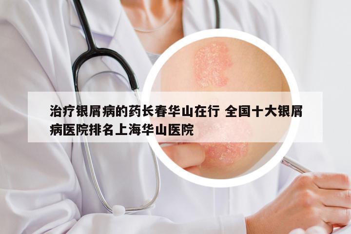 治疗银屑病的药长春华山在行 全国十大银屑病医院排名上海华山医院