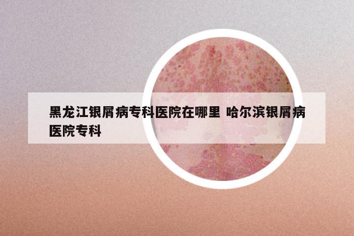 黑龙江银屑病专科医院在哪里 哈尔滨银屑病医院专科