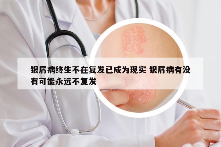 银屑病终生不在复发已成为现实 银屑病有没有可能永远不复发