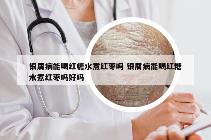 银屑病能喝红糖水煮红枣吗 银屑病能喝红糖水煮红枣吗好吗