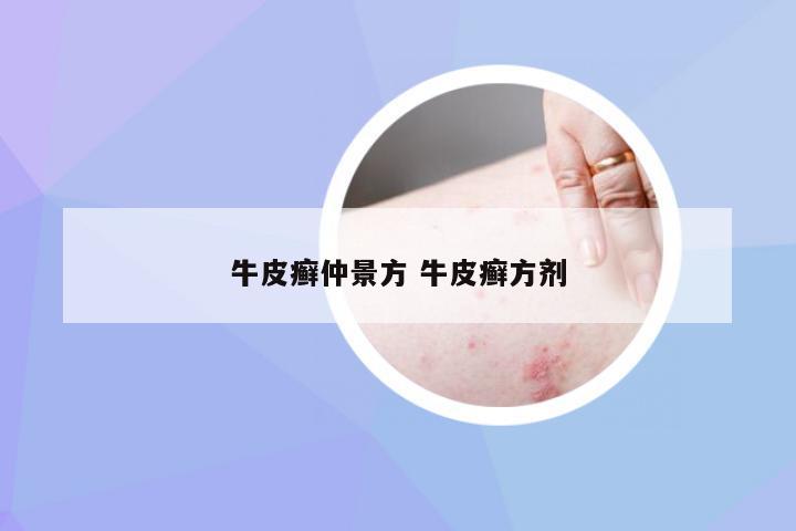 牛皮癣仲景方 牛皮癣方剂