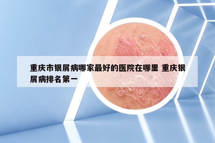 重庆市银屑病哪家最好的医院在哪里 重庆银屑病排名第一