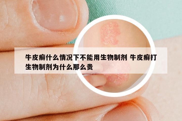 牛皮癣什么情况下不能用生物制剂 牛皮癣打生物制剂为什么那么贵