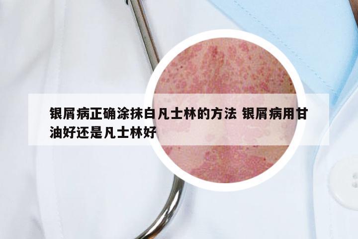 银屑病正确涂抹白凡士林的方法 银屑病用甘油好还是凡士林好