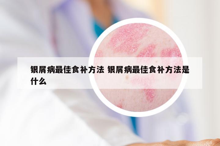 银屑病最佳食补方法 银屑病最佳食补方法是什么