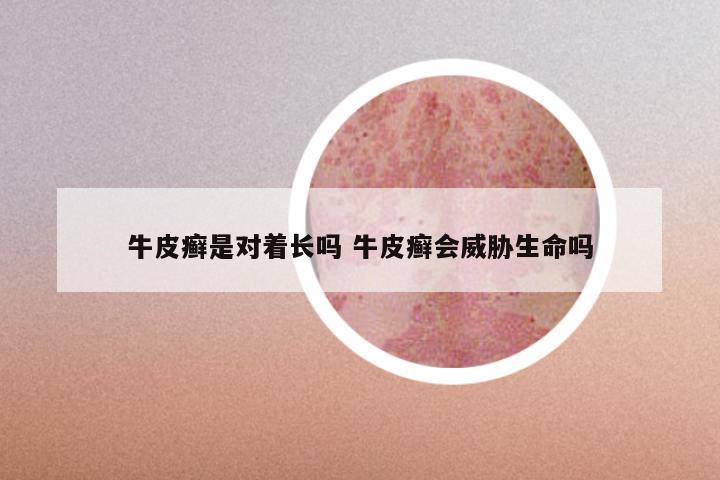 牛皮癣是对着长吗 牛皮癣会威胁生命吗