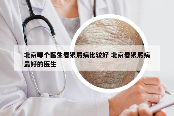 北京哪个医生看银屑病比较好 北京看银屑病最好的医生