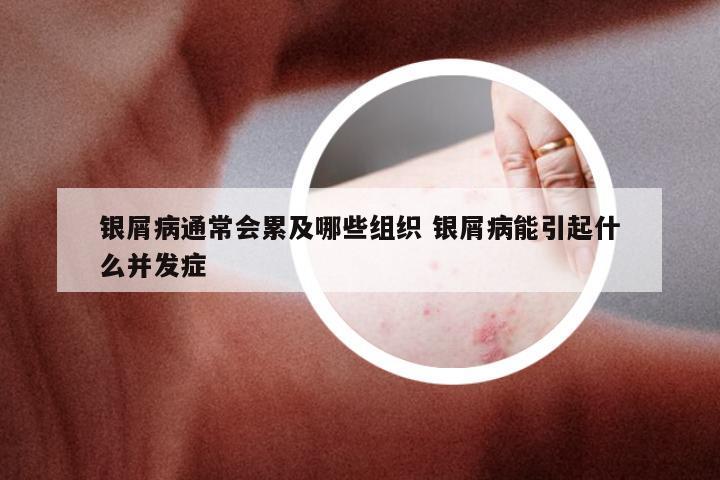 银屑病通常会累及哪些组织 银屑病能引起什么并发症