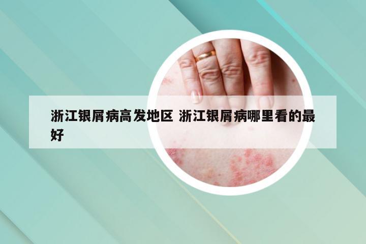 浙江银屑病高发地区 浙江银屑病哪里看的最好