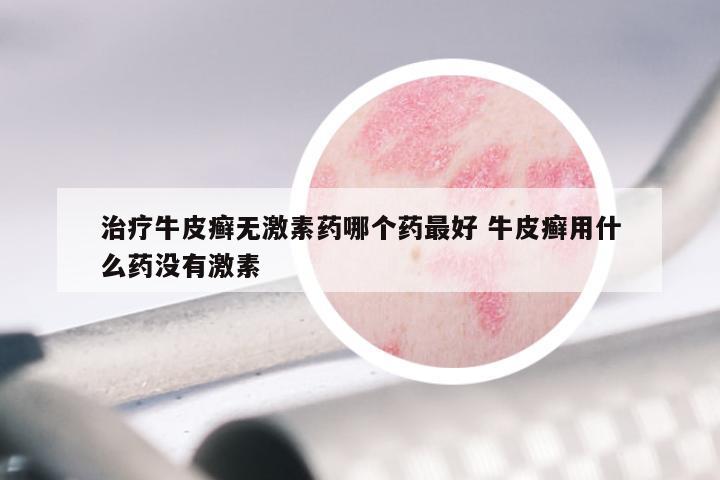 治疗牛皮癣无激素药哪个药最好 牛皮癣用什么药没有激素