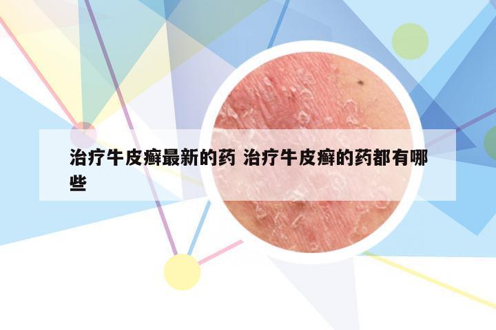 治疗牛皮癣最新的药 治疗牛皮癣的药都有哪些