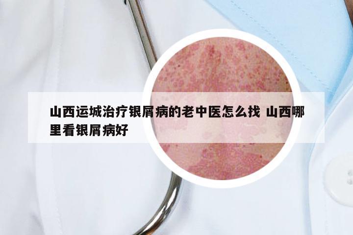 山西运城治疗银屑病的老中医怎么找 山西哪里看银屑病好