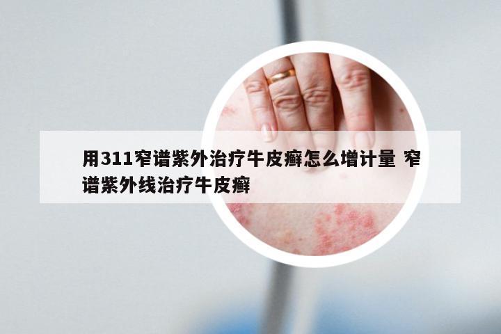 用311窄谱紫外治疗牛皮癣怎么增计量 窄谱紫外线治疗牛皮癣