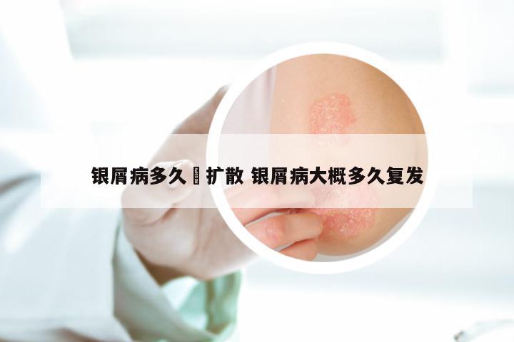 银屑病多久鞥扩散 银屑病大概多久复发