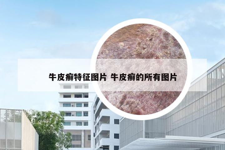 牛皮癣特征图片 牛皮癣的所有图片