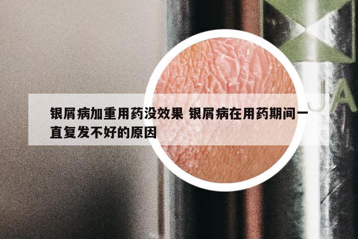 银屑病加重用药没效果 银屑病在用药期间一直复发不好的原因