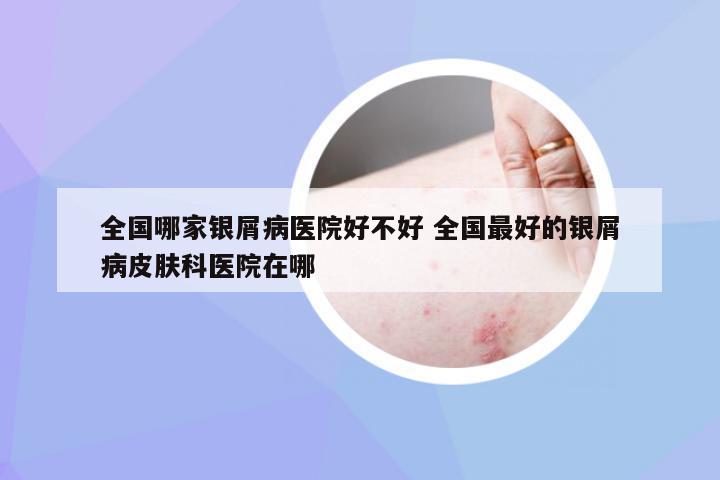 全国哪家银屑病医院好不好 全国最好的银屑病皮肤科医院在哪