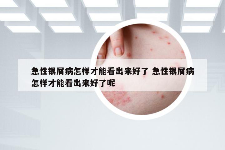 急性银屑病怎样才能看出来好了 急性银屑病怎样才能看出来好了呢