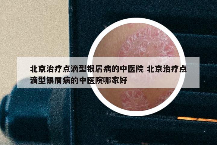 北京治疗点滴型银屑病的中医院 北京治疗点滴型银屑病的中医院哪家好