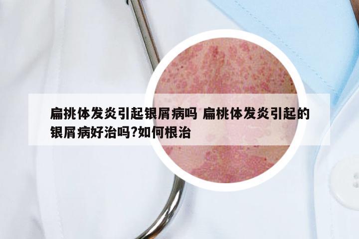 扁挑体发炎引起银屑病吗 扁桃体发炎引起的银屑病好治吗?如何根治
