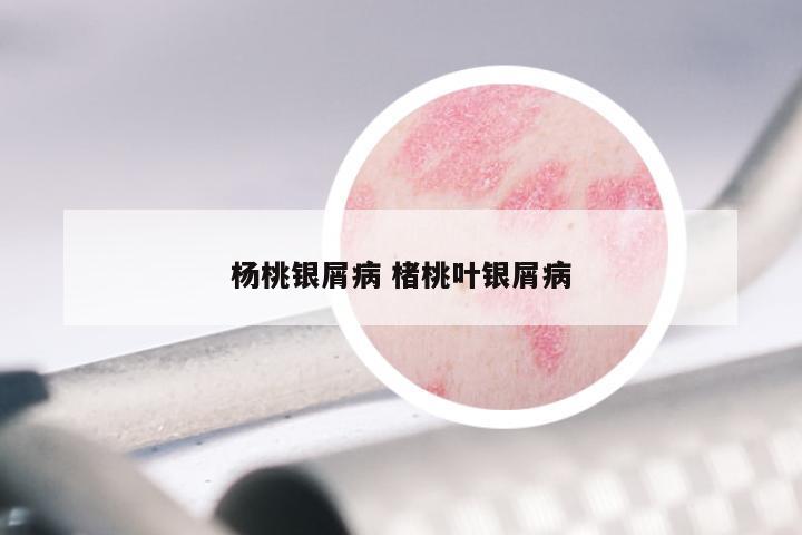 杨桃银屑病 楮桃叶银屑病