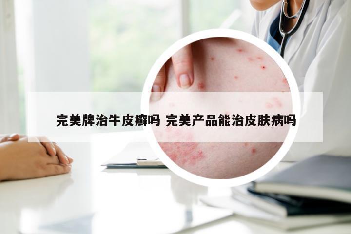 完美牌治牛皮癣吗 完美产品能治皮肤病吗