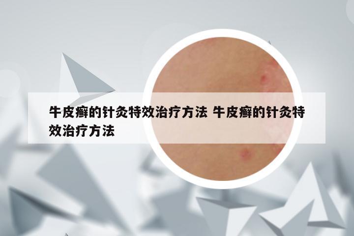 牛皮癣的针灸特效治疗方法 牛皮癣的针灸特效治疗方法