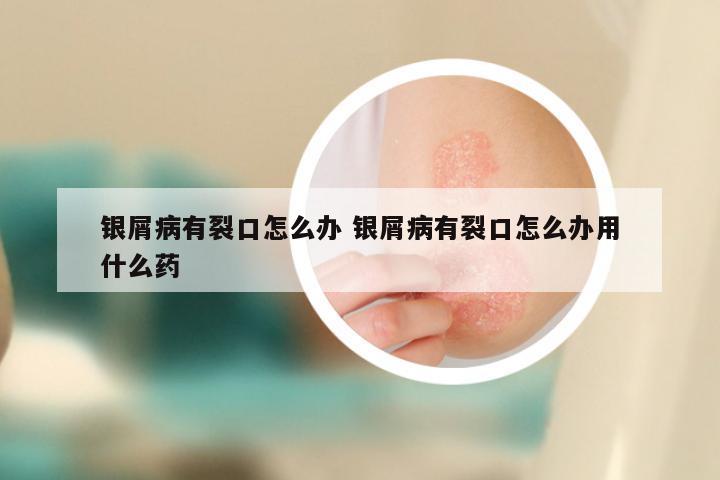 银屑病有裂口怎么办 银屑病有裂口怎么办用什么药