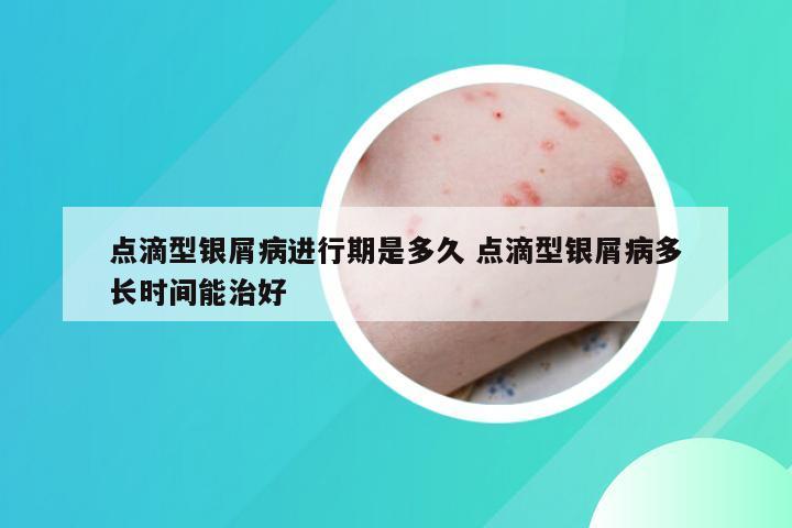 点滴型银屑病进行期是多久 点滴型银屑病多长时间能治好