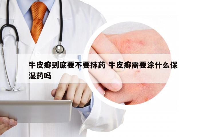 牛皮癣到底要不要抹药 牛皮癣需要涂什么保湿药吗