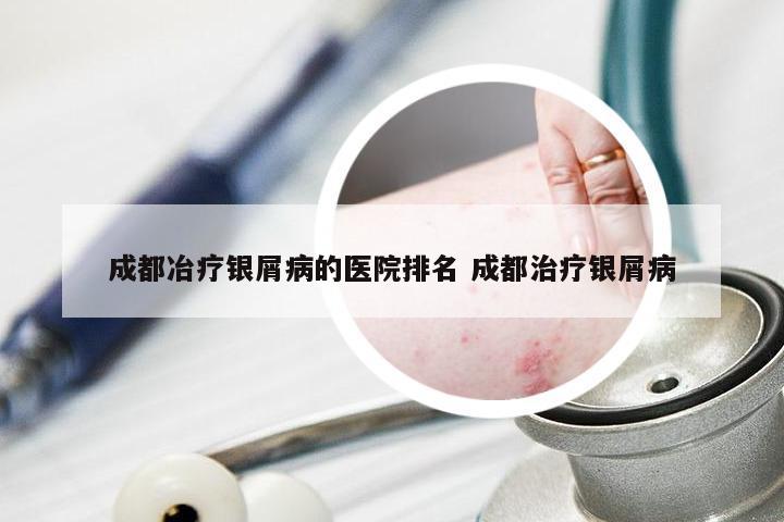 成都冶疗银屑病的医院排名 成都治疗银屑病