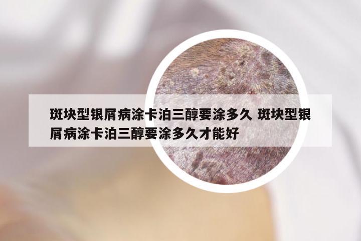 斑块型银屑病涂卡泊三醇要涂多久 斑块型银屑病涂卡泊三醇要涂多久才能好