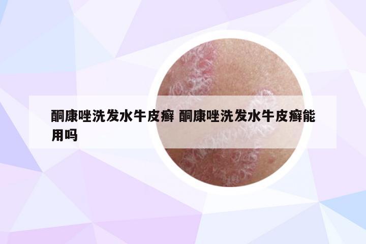 酮康唑洗发水牛皮癣 酮康唑洗发水牛皮癣能用吗